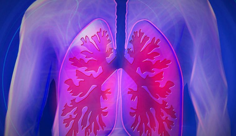Artificial Intelligence Can Help Detect Lung Cancer Even in the Early Stages